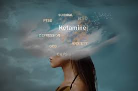 An Approach to Ketamine Treatment for Depression In Miami, Florida